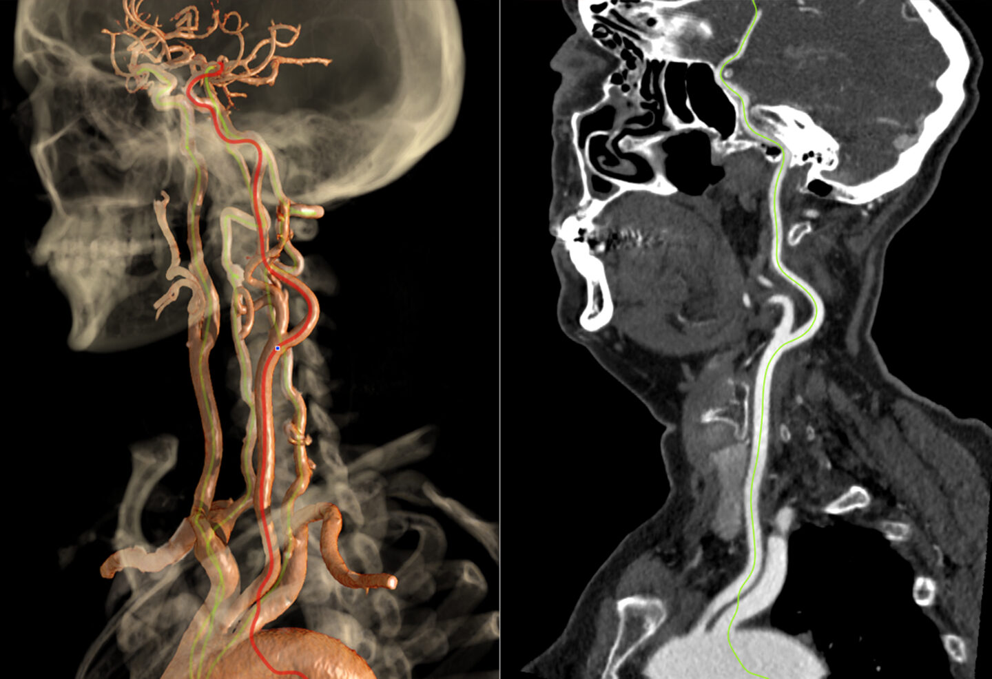 carotid imaging photo from Vital software.